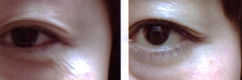 complicationofBotulinum Toxininjection